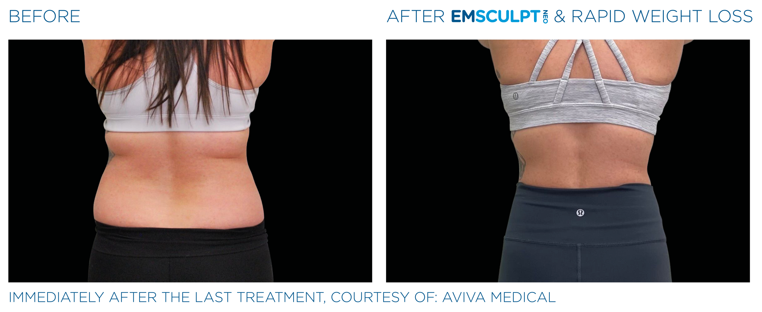 Emsculpt_Neo-Weight-Loss_PIC_Ba-card-female-lateral-abdomen-014_ENUS100